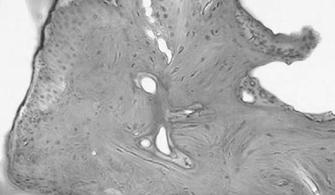 Az otosclerosisra jellemző CD46 variánsok molekuláris biológiai jellemzése
