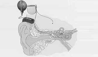 Cochlearis implantáció